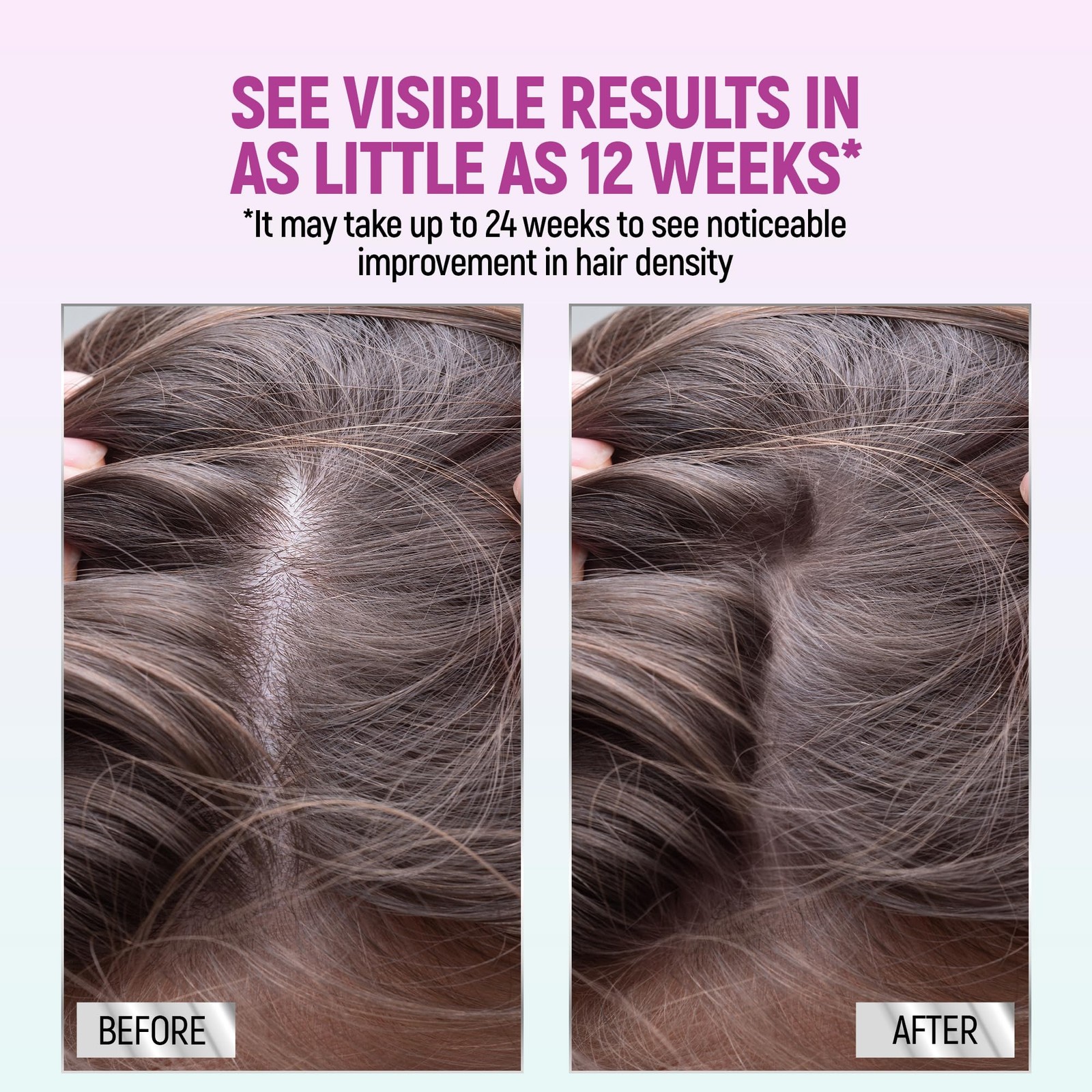 Rogaine 5% Minoxidil Foam for Women Hair Growth Thinning Treatment 2 Month