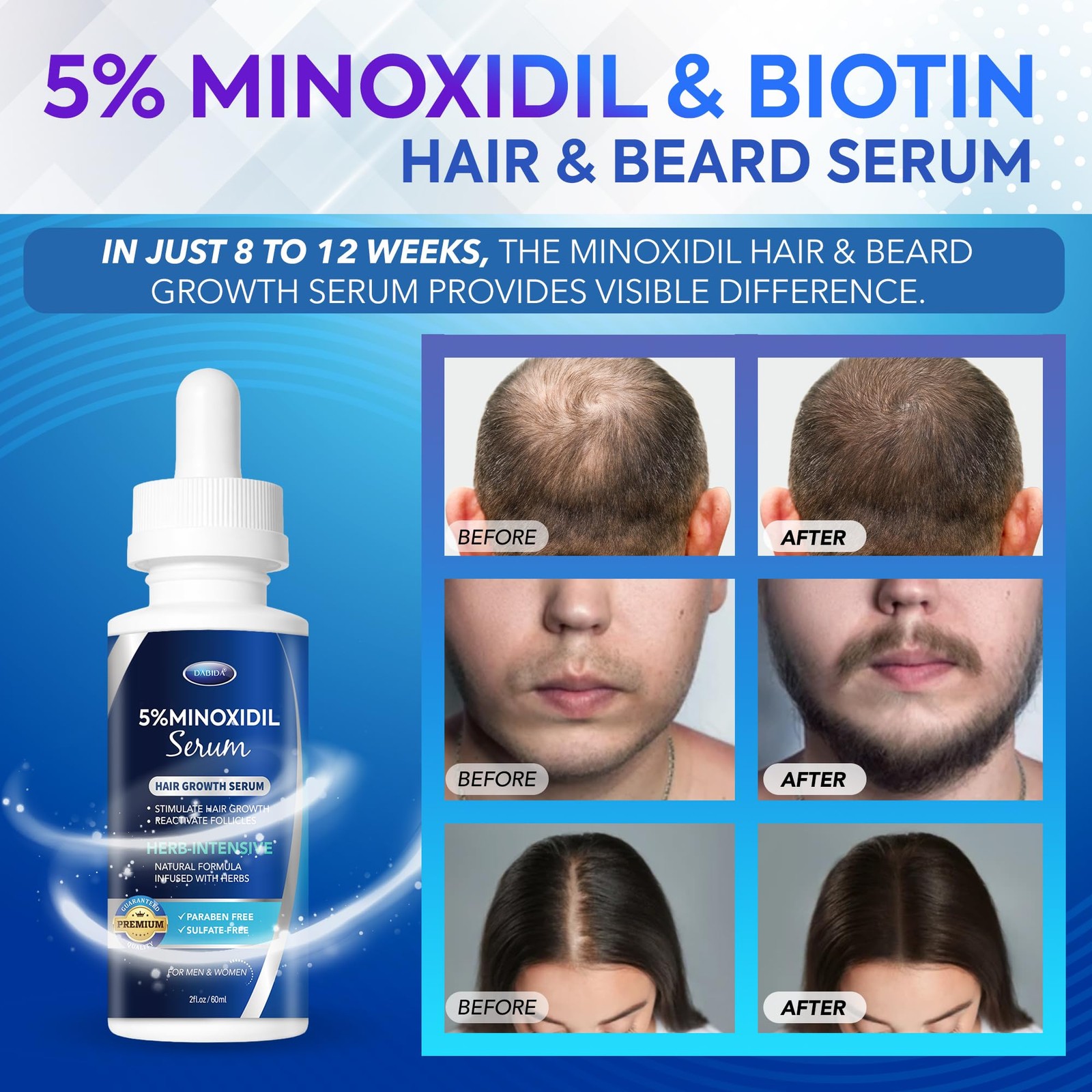 5% Minoxidil Hair Growth for Men and Women: Extra Strength Beard Regrowth Tre…
