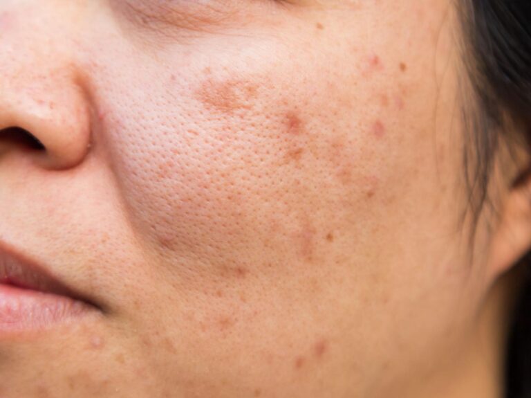 chemical peel hyperpigmentation