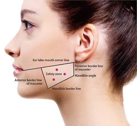 masseter botox